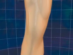 Osteoartrit